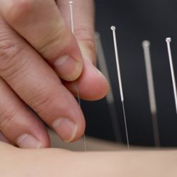 Distal-Needle-Acupuncture-image-by-healthdemia.com