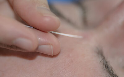 Facial & Cosmetic Acupuncture